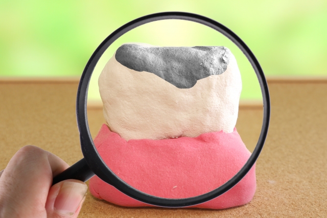 歯の詰め物
