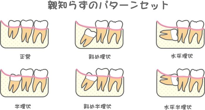 親知らずのパターンセット
